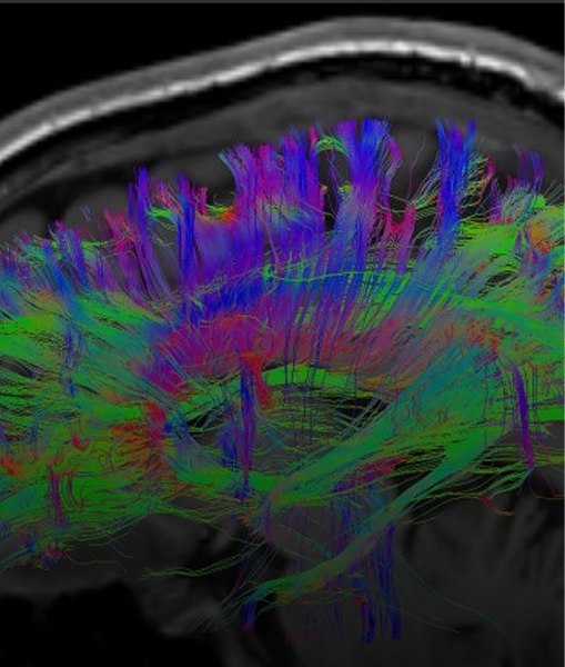 Paroles de chercheur : Dr Anne Kerbrat, neurologue au CHU de Rennes